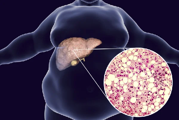 Fatty Liver Disease