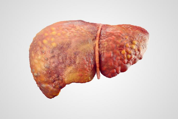 Hepatitis B&C Liver Infections