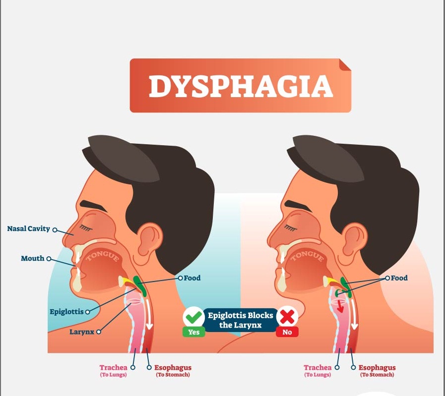 Dysphagia (Swallowing Difficulties)