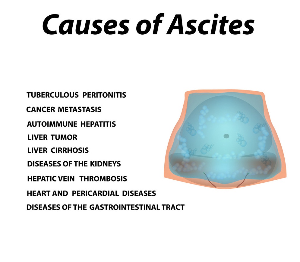 Ascites (Fluid In Abdomen)