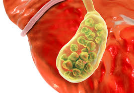 Gallstones