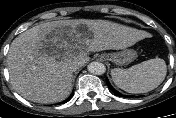 Liver Abscess