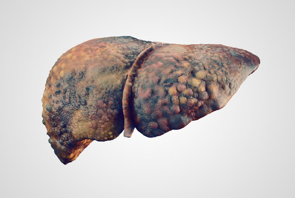 Alcoholic Liver Disease